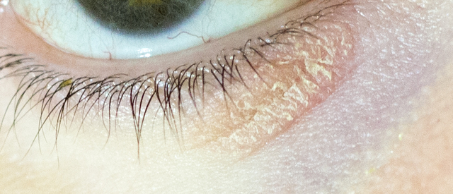 pikkelysömör kezelése a szem közelében kerek vörös folt a bőrön