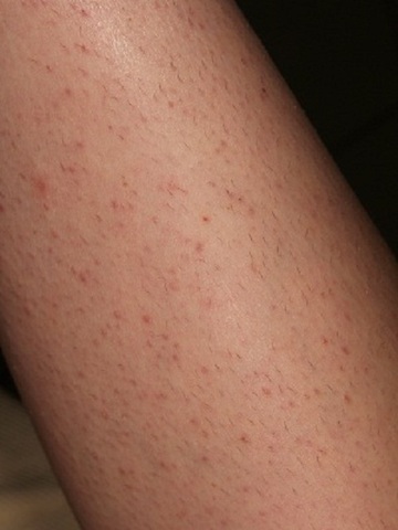 A lábak bőrén a vörös foltok okai és a kezelési módok - Chicken pox November