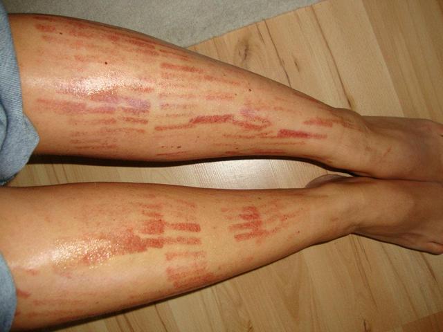 vörös foltos lábak az epilátor után