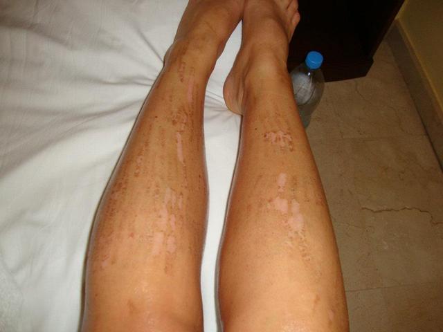 Vörös foltok gyantázás után a lábakon. Pikkelysömör kezelés komplex terápia