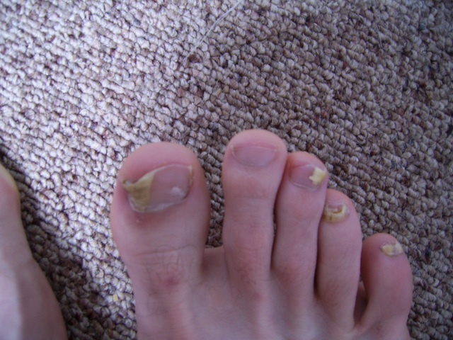 nail fungush foot eltávolítása melyek a tünetek a gomba a körmökön