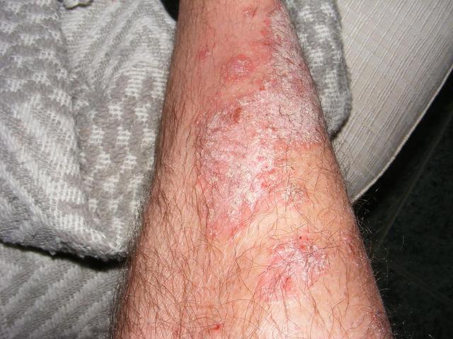 psoriasis medscape vörös foltok a lábakon nagyon viszketnek